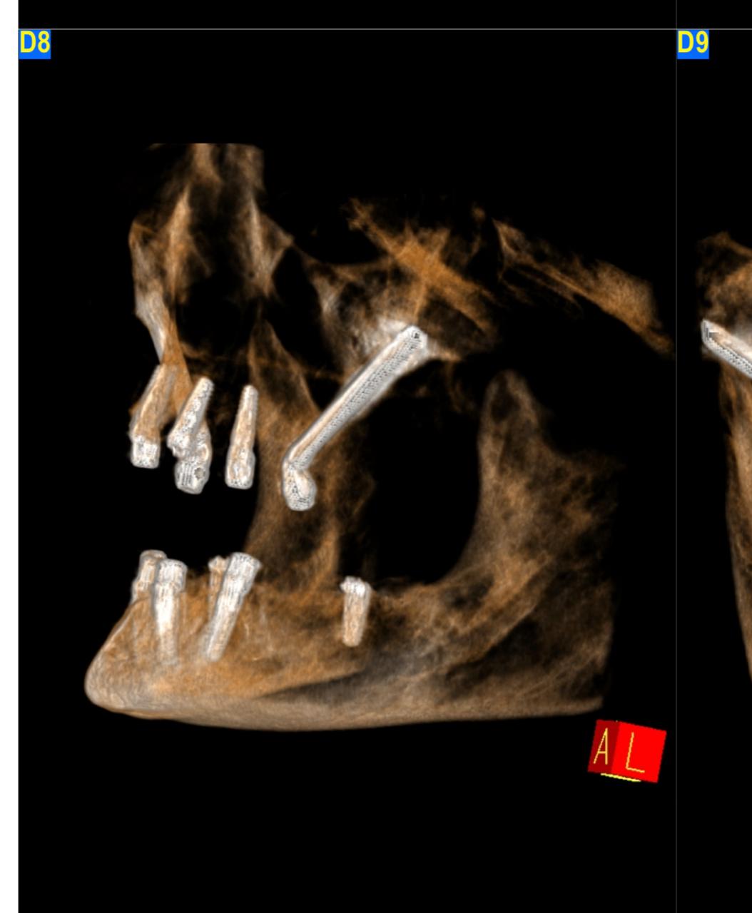 Zygomatic Implants 