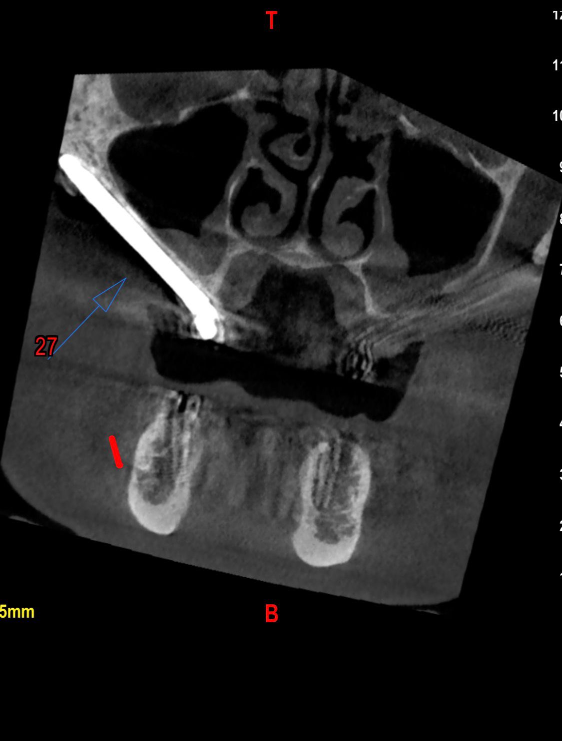 Zygomatic Implants 