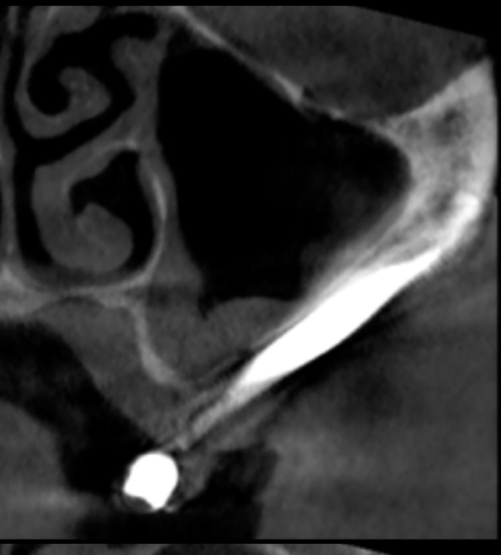 Zygomatic Implants 