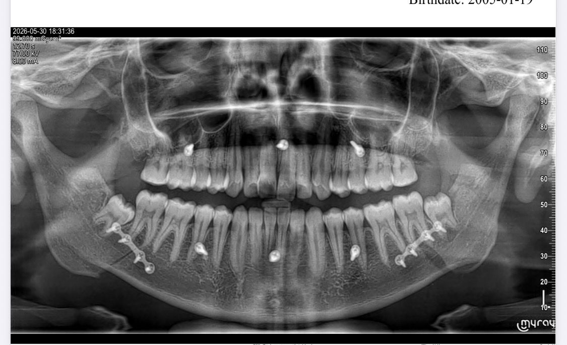 Jaw Corrective Surgery (Orthognathic)