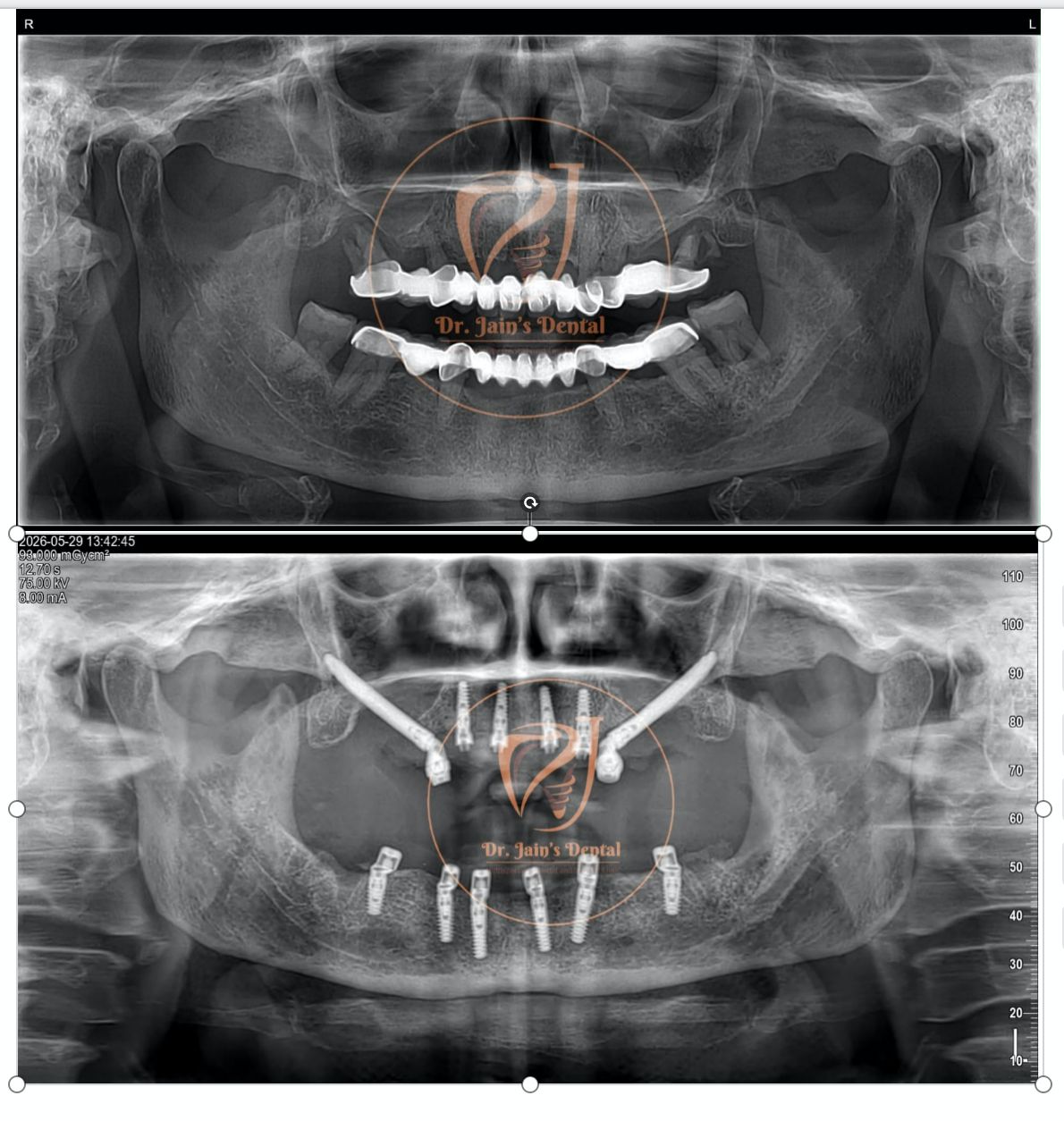 Zygomatic Implants 