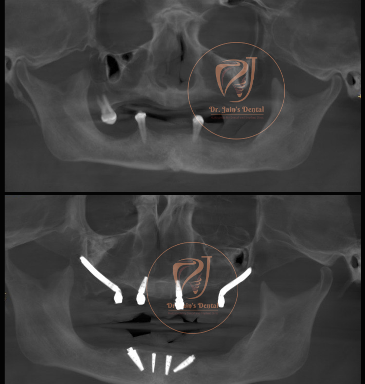 Zygomatic Implants 