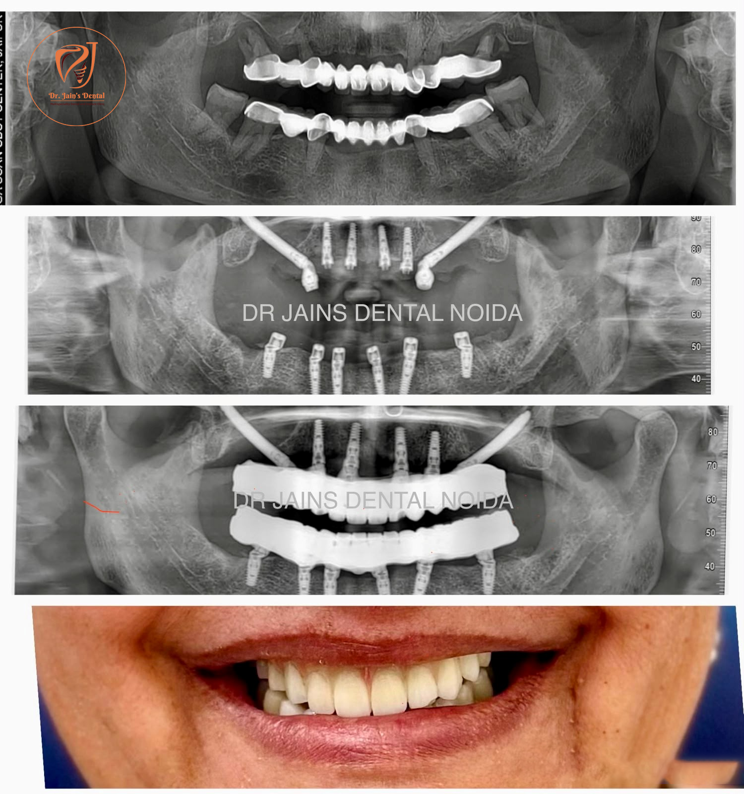 Zygomatic Implants 