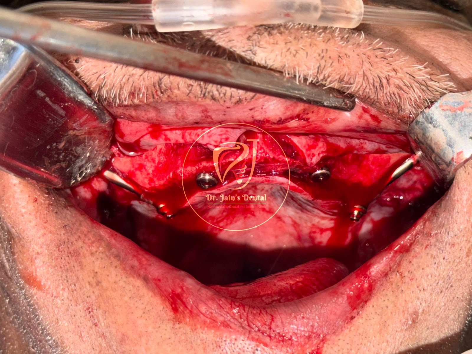 Zygomatic Implants 