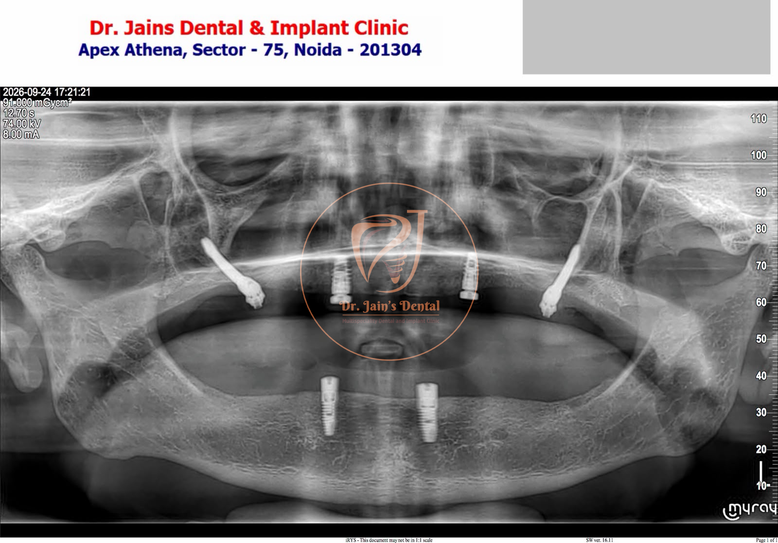 Zygomatic Implants 